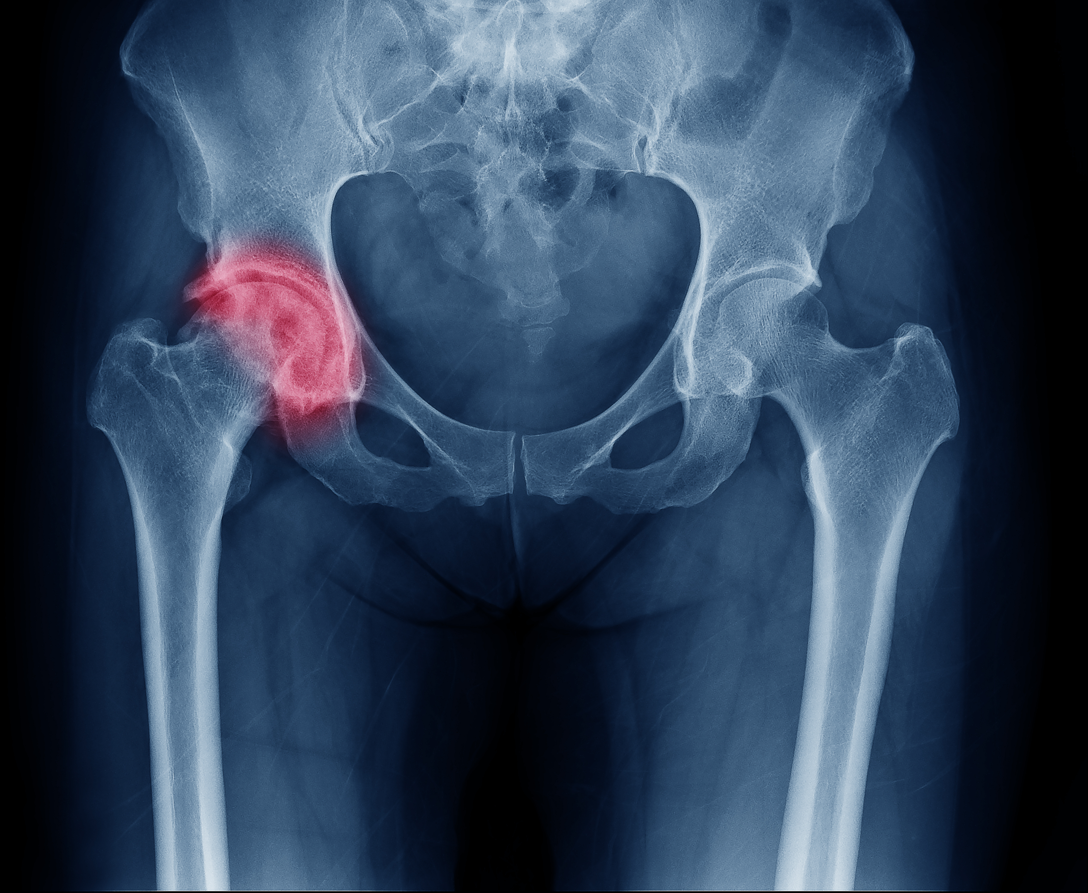 Hip Fractures And How They Affect The Elderly In Assisted Living Facilities 