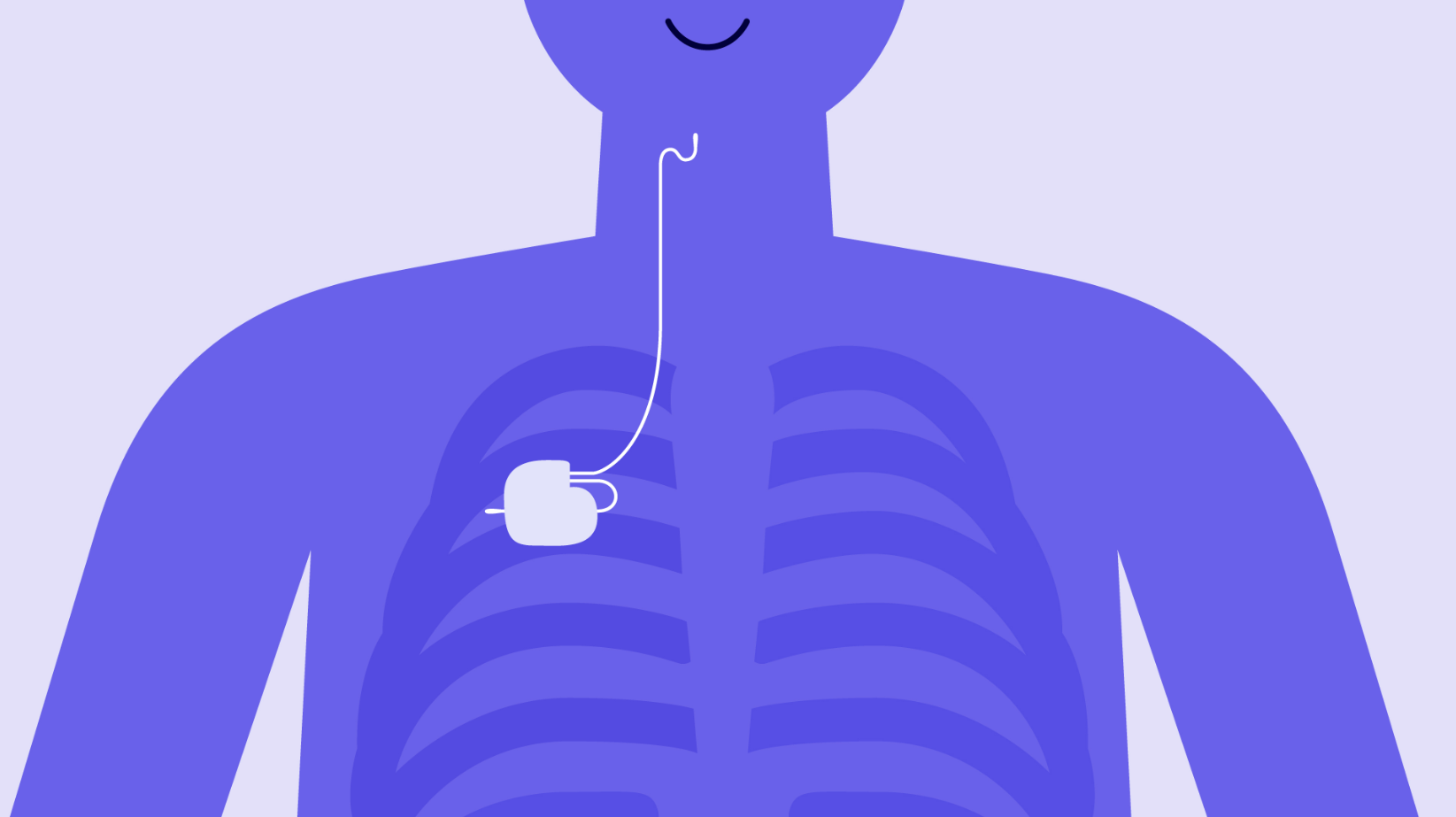 Illustration showing implanted Inspire device with ledes from chest up to tongue muscle.