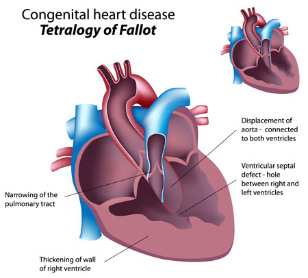 congenital heart disease chart