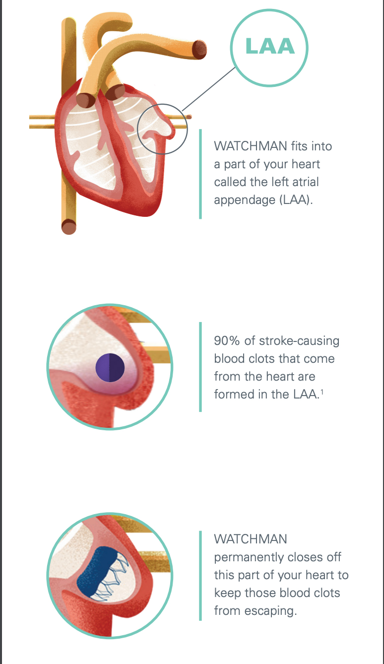 Illustration courtesy of Boston Scientific